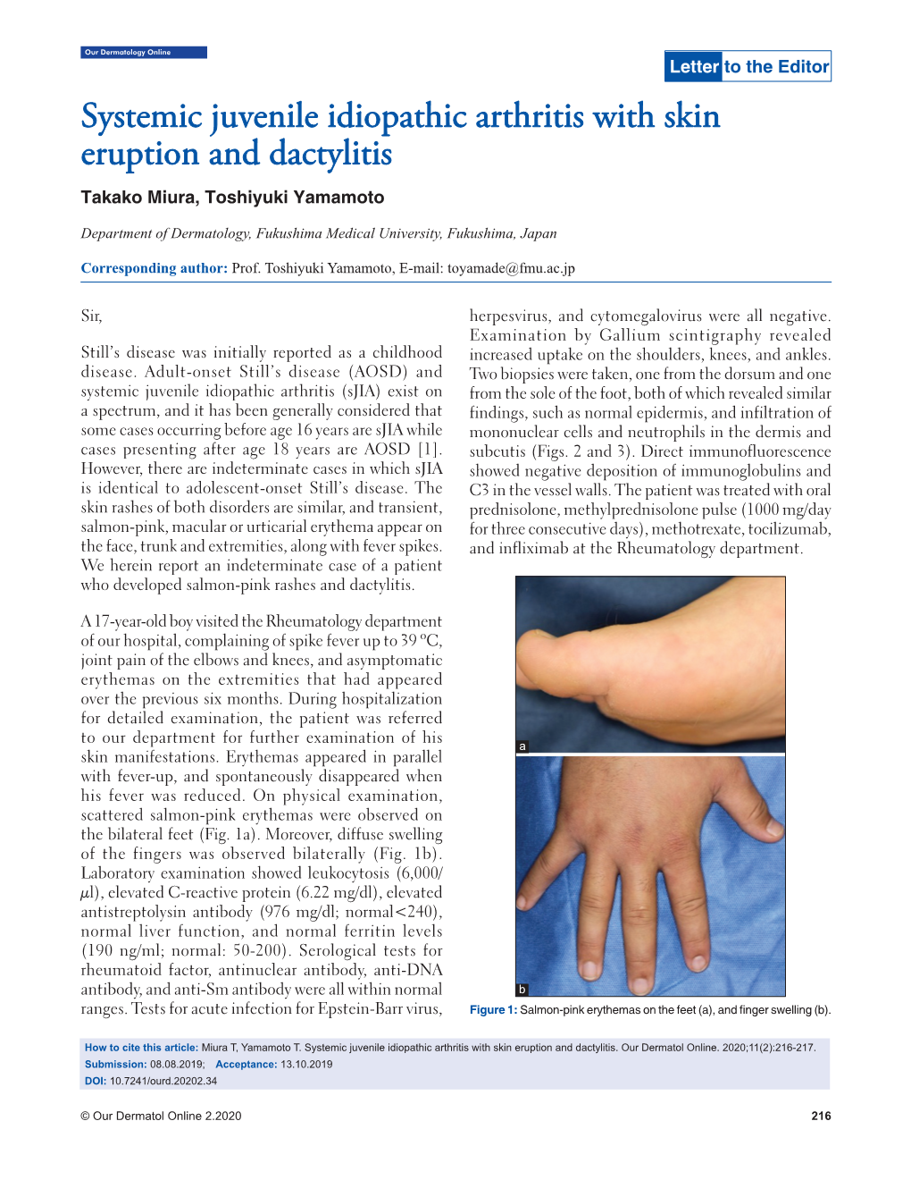 Systemic Juvenile Idiopathic Arthritis with Skin Eruption and Dactylitis