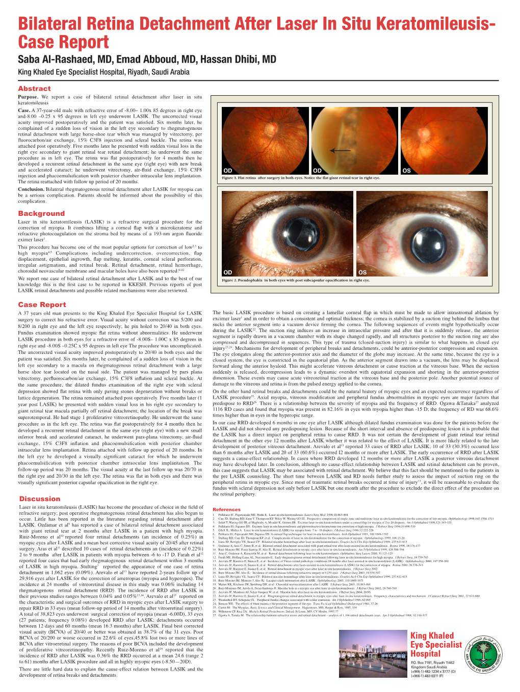 Bilateral Retina Detachment After Laser in Situ