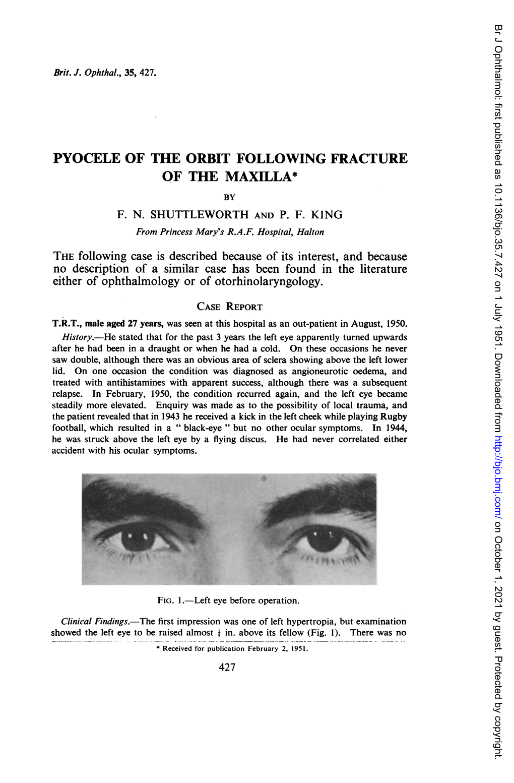 Pyocele of the Orbit Following Fracture of the Maxilla* by F