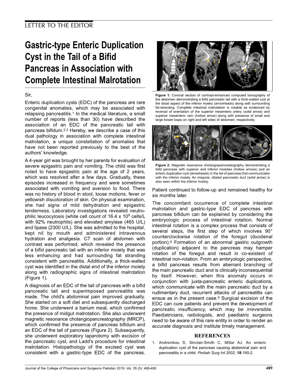 Gastric-Type Enteric Duplication Cyst in the Tail of a Bifid Pancreas in Association with Complete Intestinal Malrotation