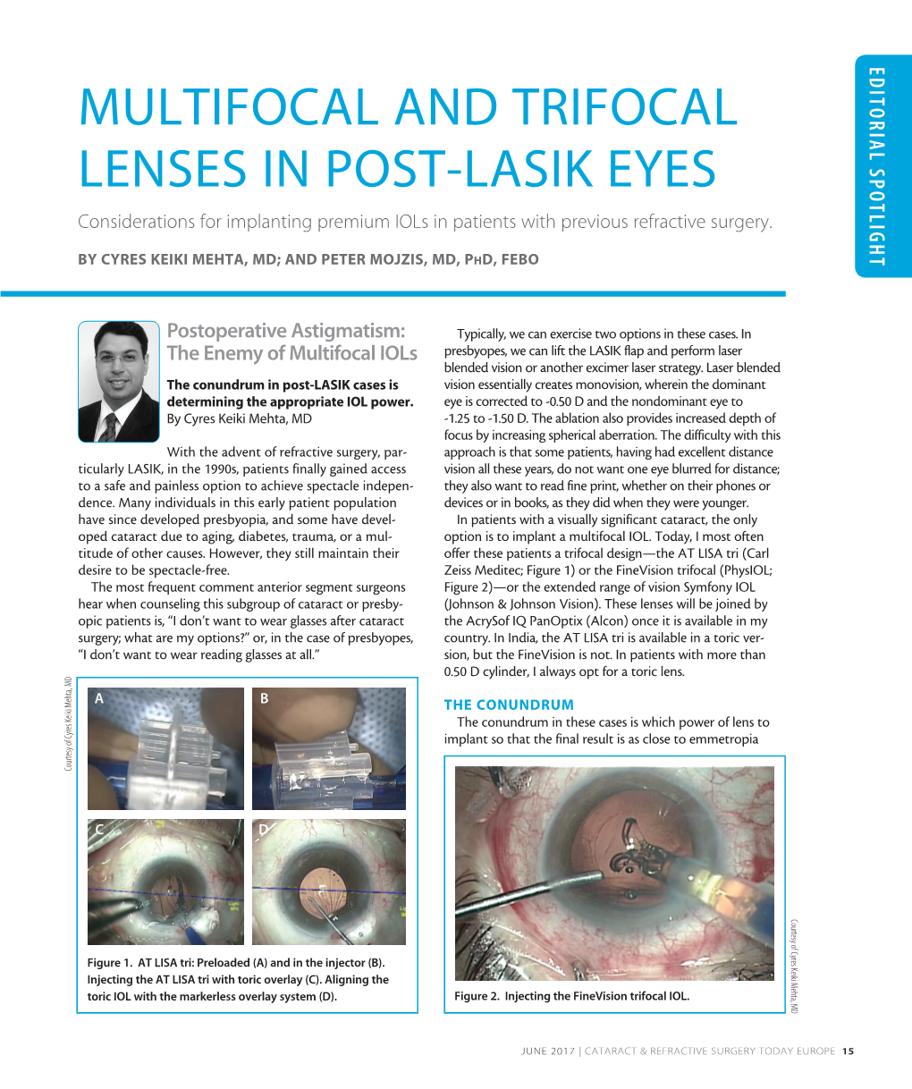 Multifocal and Trifocal Lenses in Post-Lasik Eyes