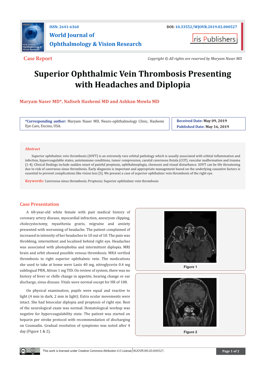 Superior Ophthalmic Vein Thrombosis Presenting with Headaches and Diplopia