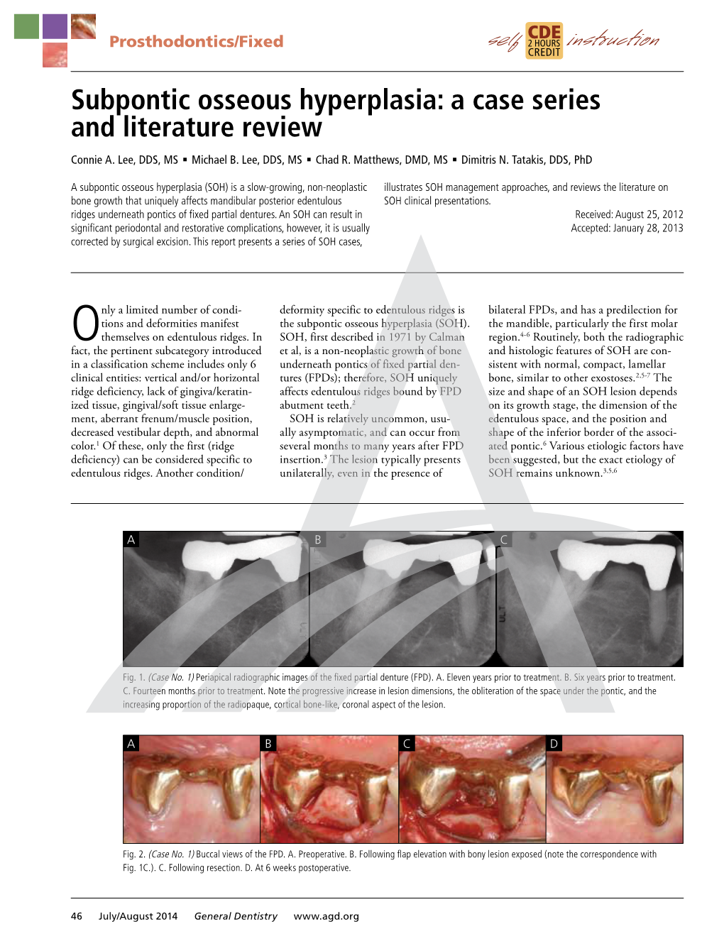 Subpontic Osseous Hyperplasia: a Case Series and Literature Review