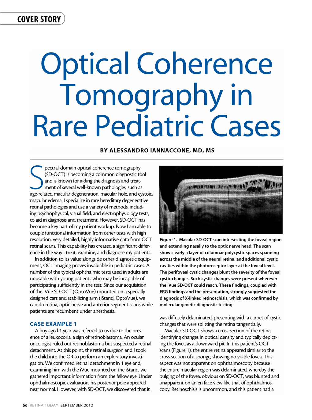 Optical Coherence Tomography in Rare Pediatric Cases by Alessandro Iannaccone, MD, MS