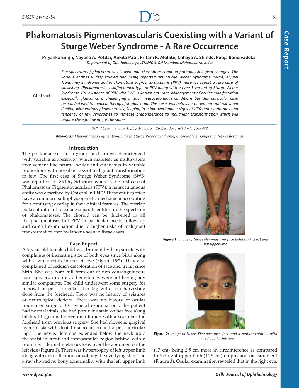 Phakomatosis Pigmentovascularis Coexisting with a Variant of Case Report Sturge Weber Syndrome - a Rare Occurrence Priyanka Singh, Nayana A