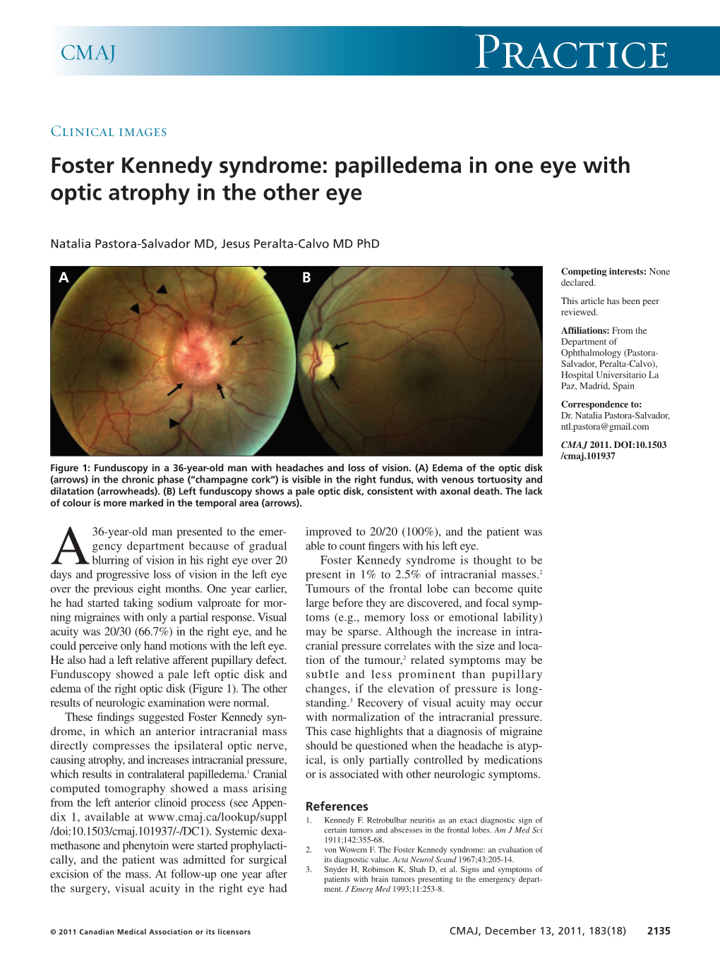 Foster Kennedy Syndrome: Papilledema in One Eye with Optic Atrophy in the Other Eye