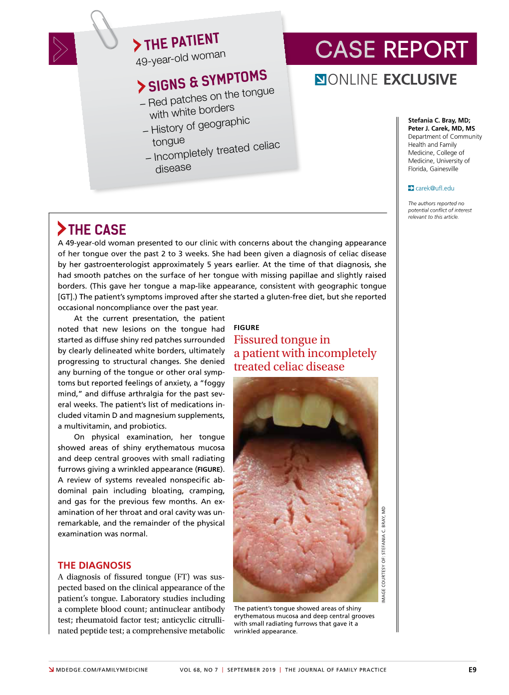 CASE REPORT 49-Year-Old Woman ONLINE EXCLUSIVE SIGNS & SYMPTOMS – Red Patches on the Tongue