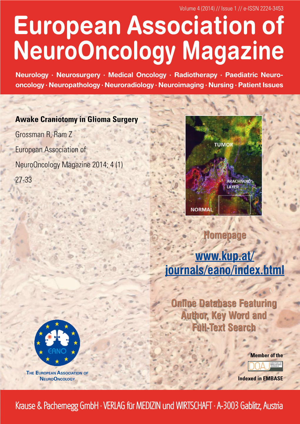 Awake Craniotomy in Glioma Surgery Grossman R, Ram Z European Association of Neurooncology Magazine 2014; 4 (1) 27-33