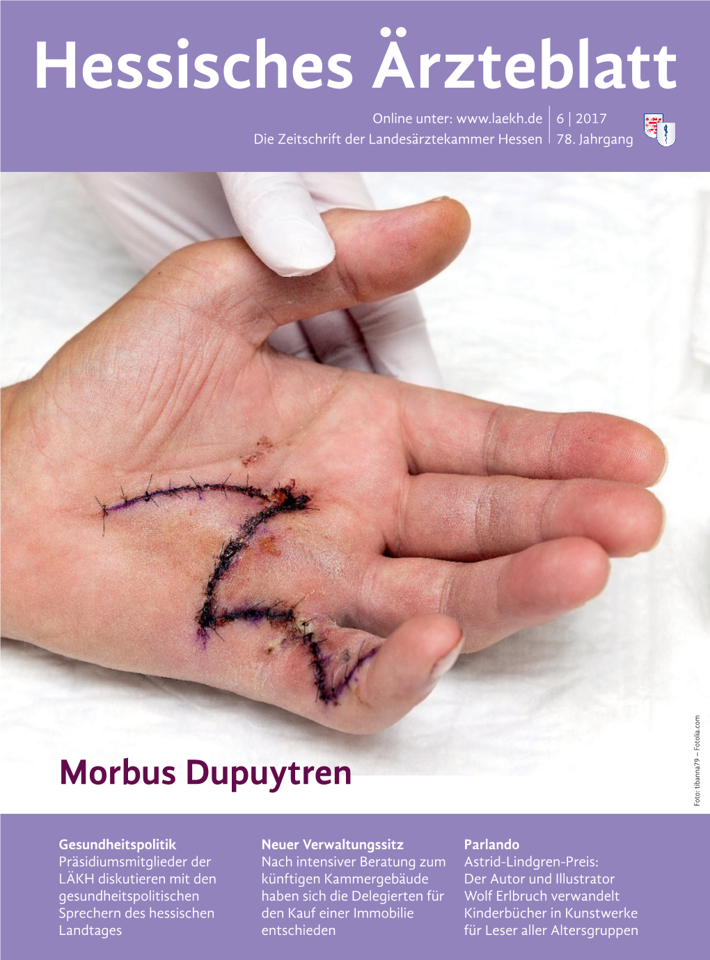 Morbus Dupuytren Foto: Tibanna79 – Fotolia.Com Tibanna79 Foto