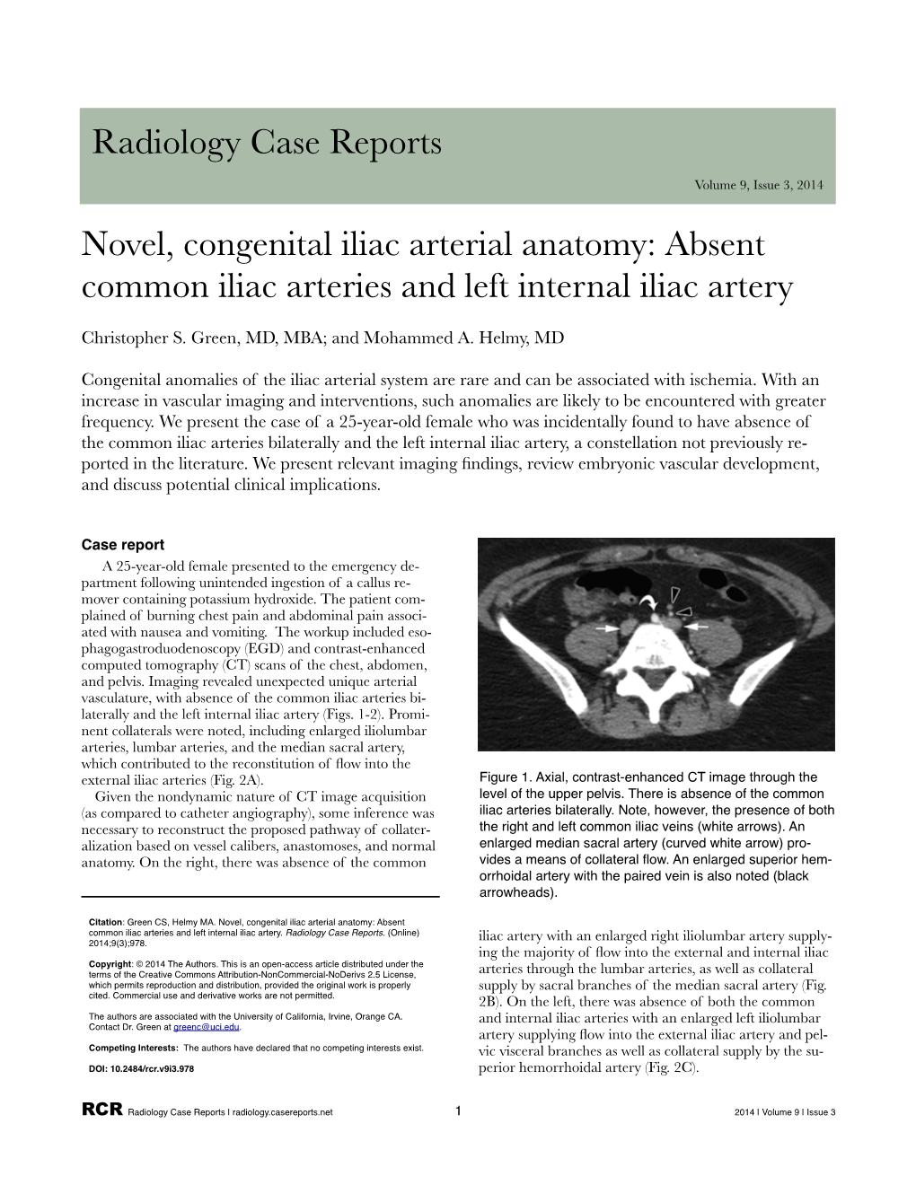 Novel, Congenital Iliac Arterial Anatomy: Absent Common Iliac Arteries and Left Internal Iliac Artery