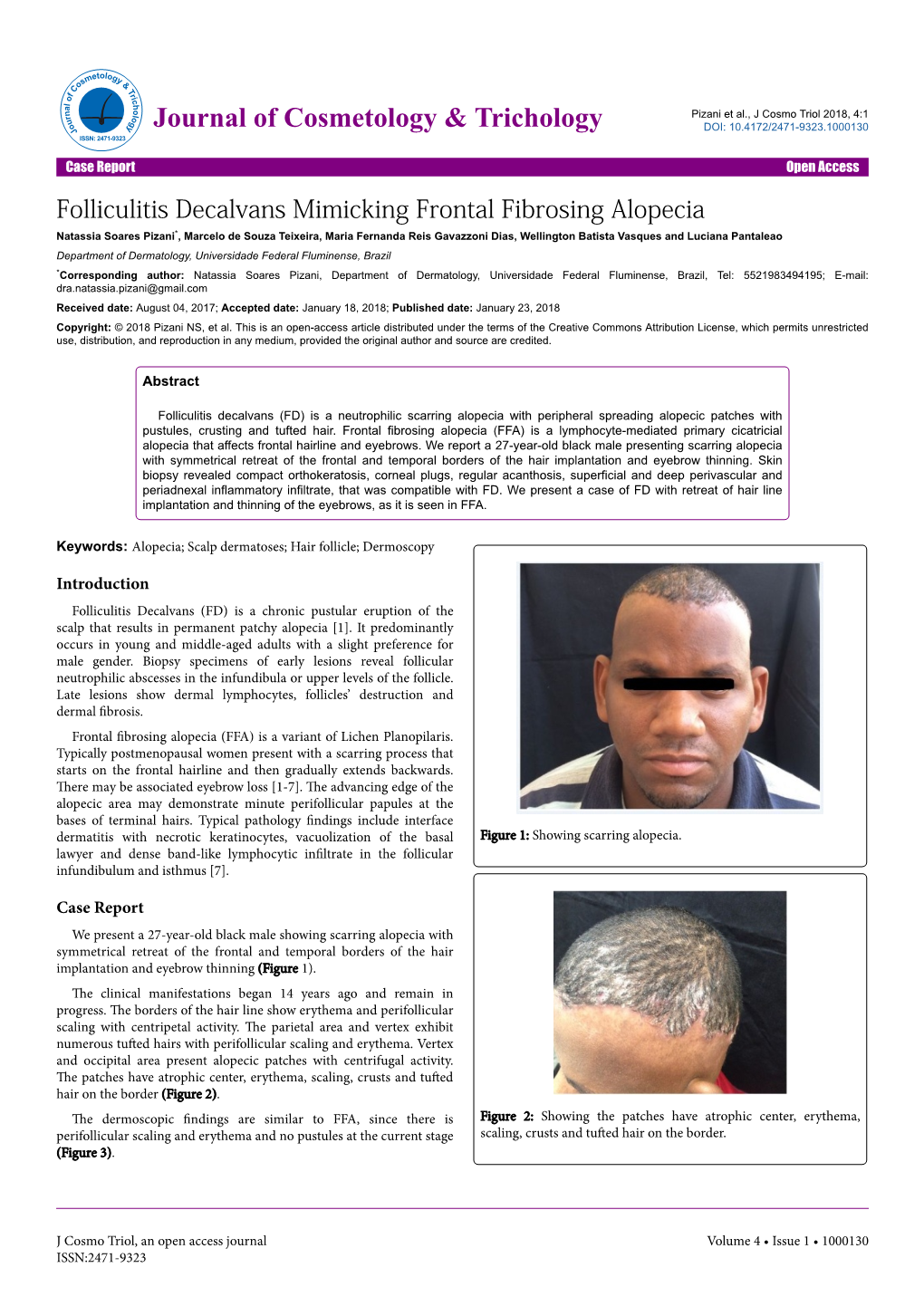 Folliculitis Decalvans Mimicking Frontal Fibrosing Alopecia