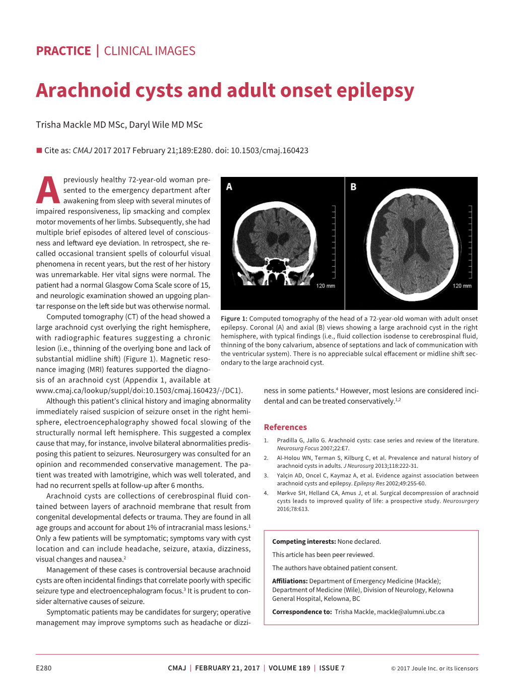 Arachnoid Cysts and Adult Onset Epilepsy