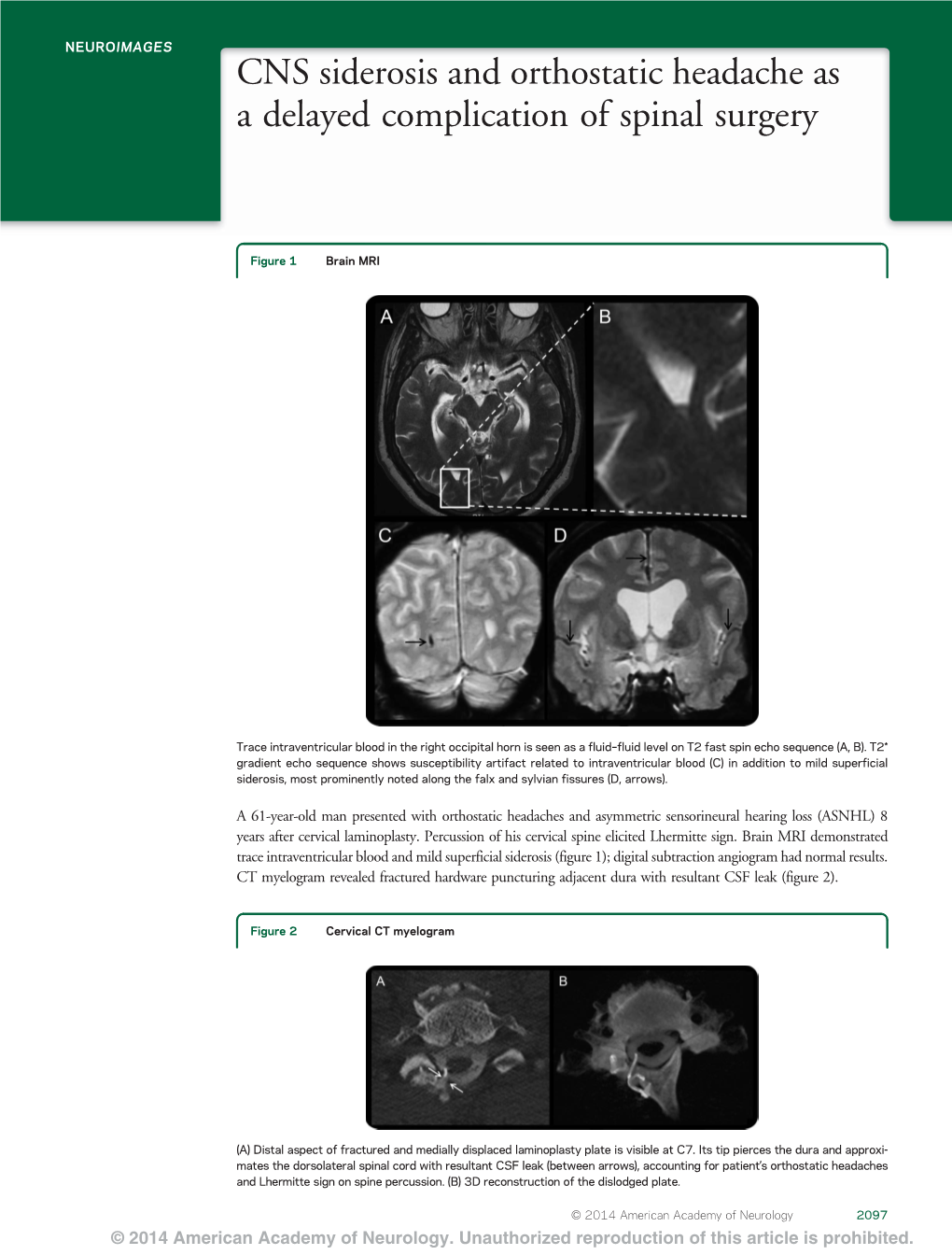 CNS Siderosis and Orthostatic Headache As a Delayed Complication of Spinal Surgery