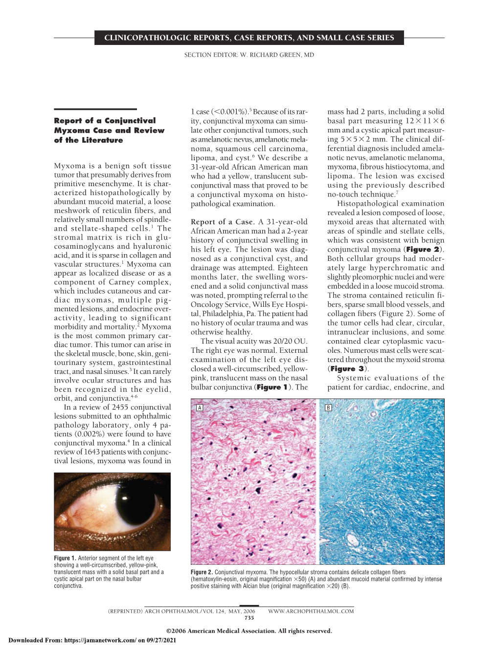 Report of a Conjunctival Myxoma Case and Review of the Literature