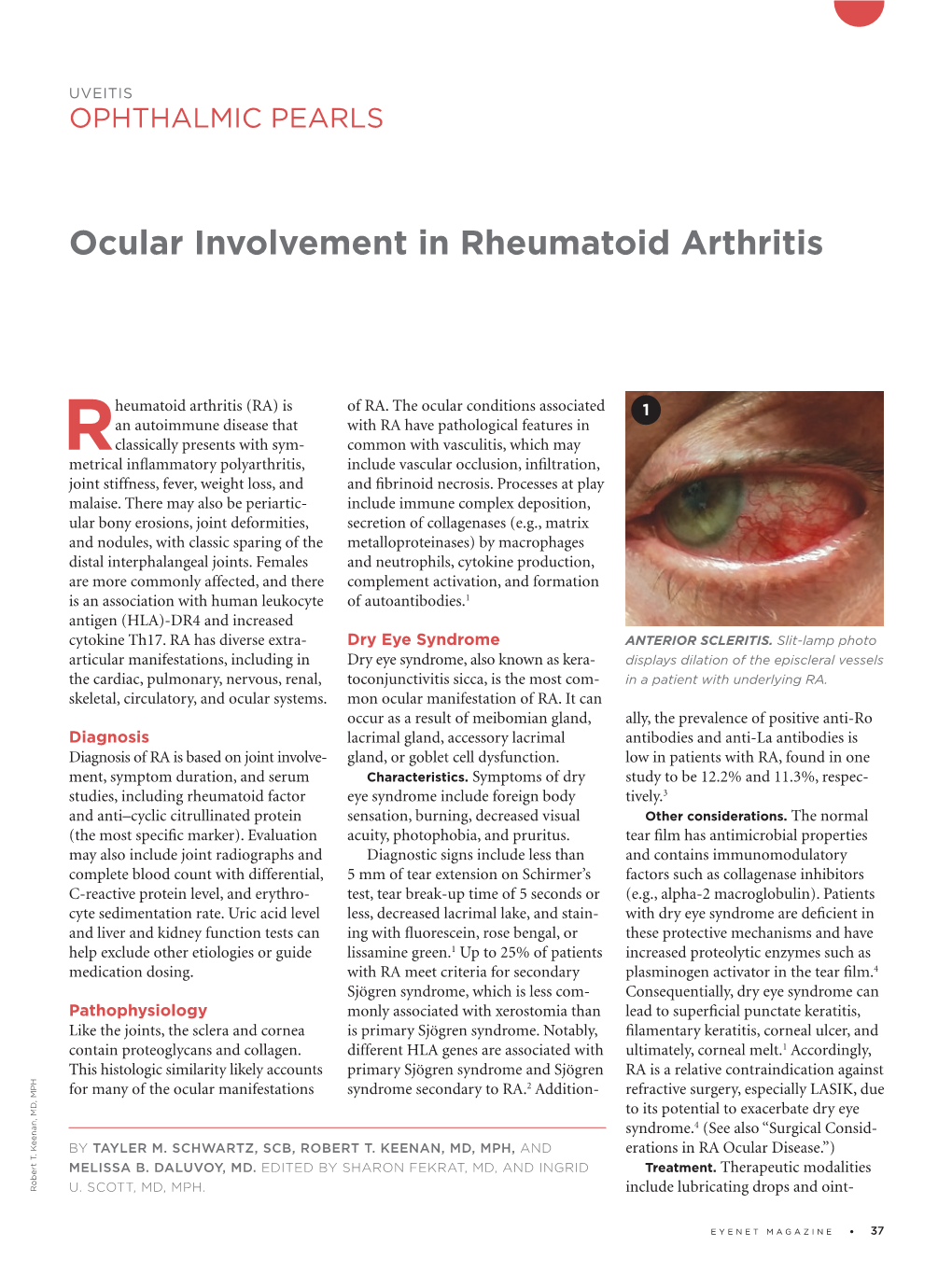 Ocular Involvement in Rheumatoid Arthritis