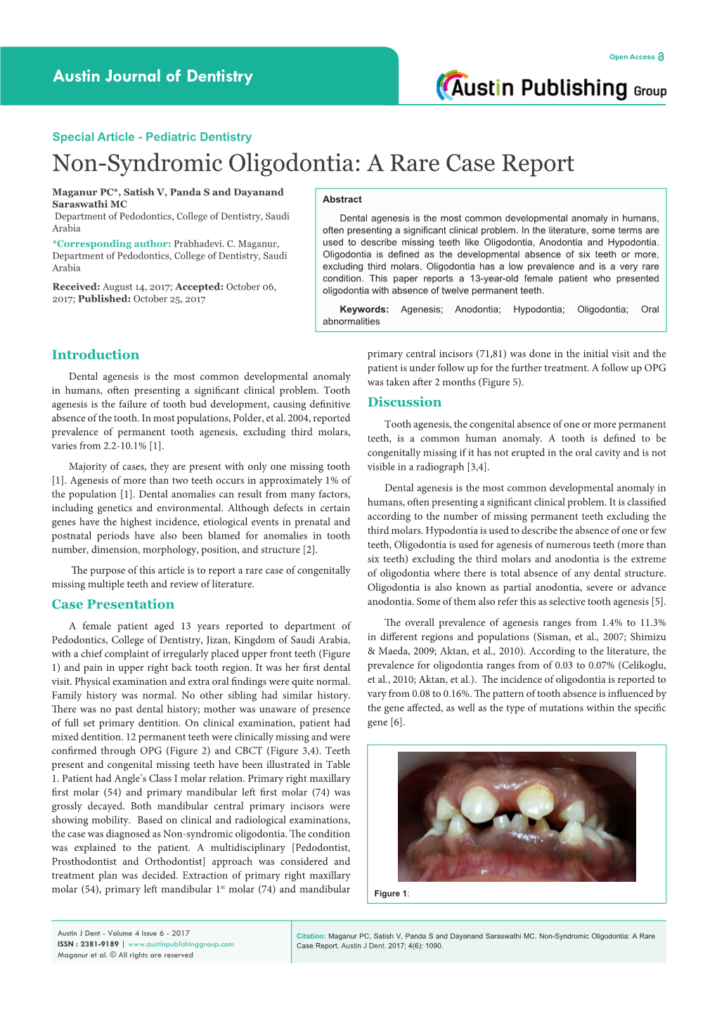 Non-Syndromic Oligodontia: a Rare Case Report