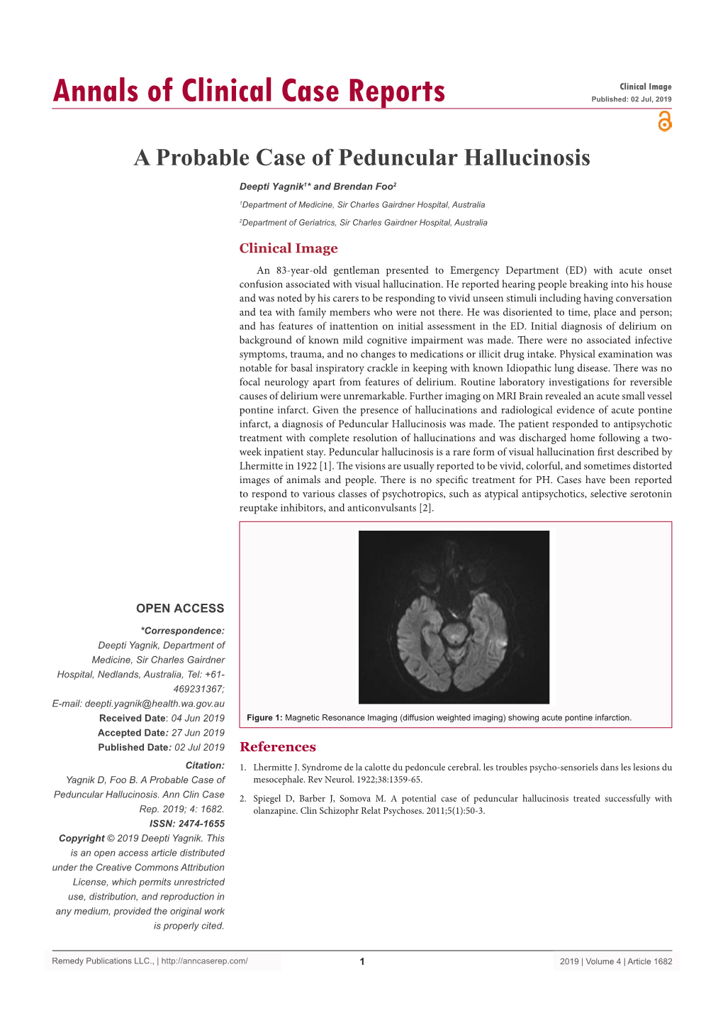 A Probable Case of Peduncular Hallucinosis
