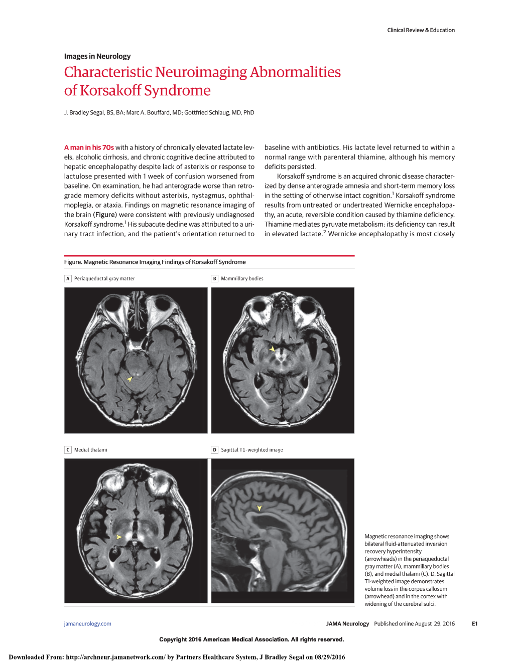 Characteristic Neuroimaging Abnormalities of Korsakoff Syndrome