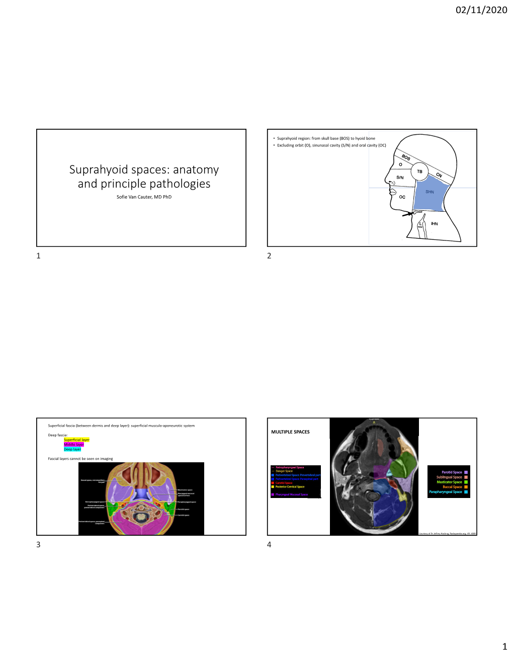 92493-Suprahyoid Space.Pdf