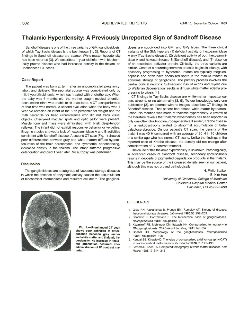 Thalamic Hyperdensity: a Previously Unreported Sign of Sandhoff Disease