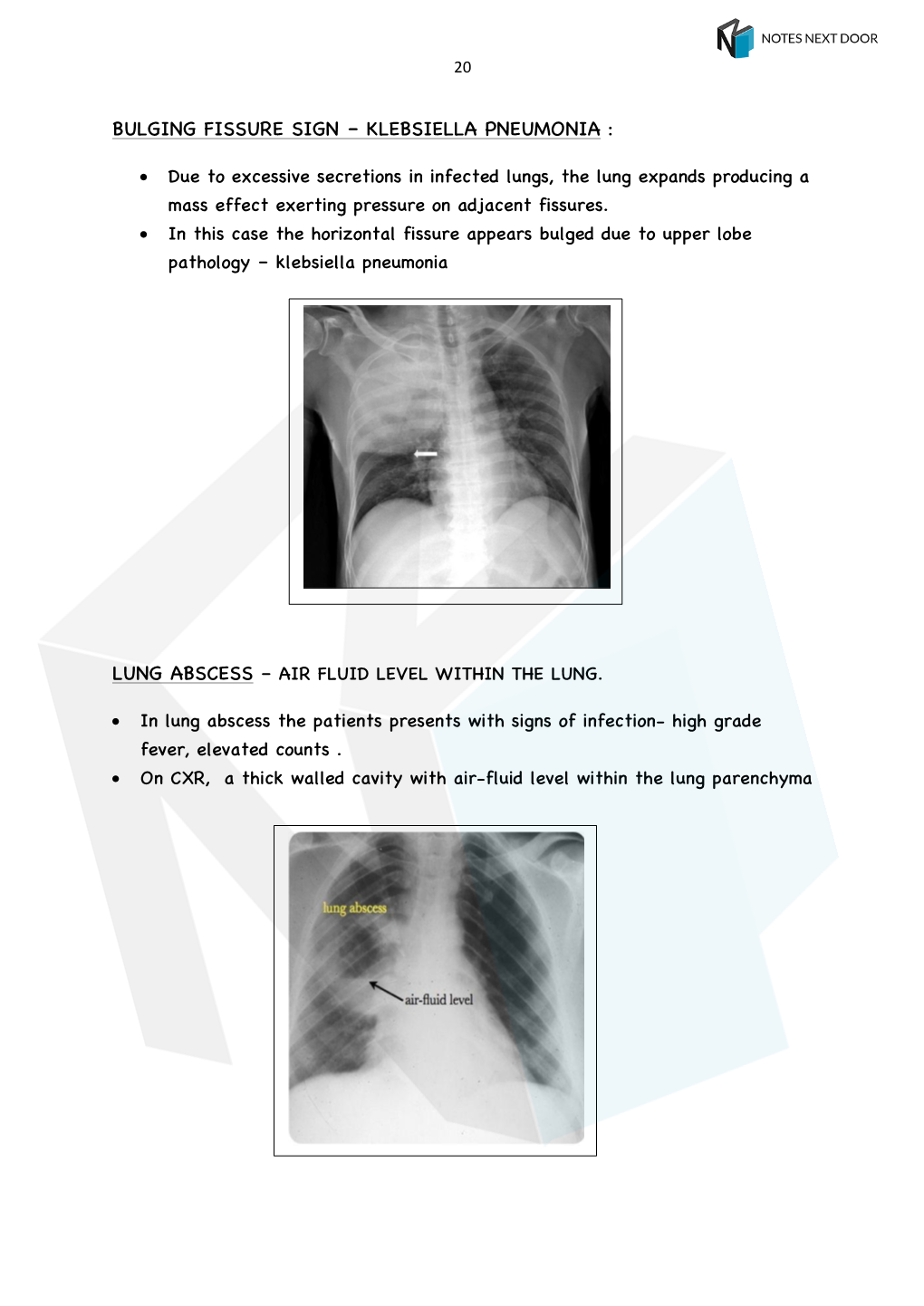 Bulging Fissure Sign – Klebsiella Pneumonia