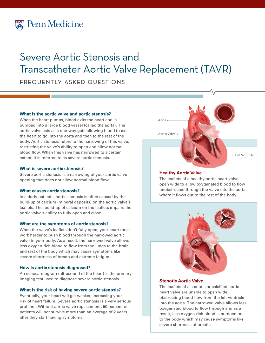 Severe Aortic Stenosis and Transcatheter Aortic Valve Replacement (TAVR) Frequently Asked Questions