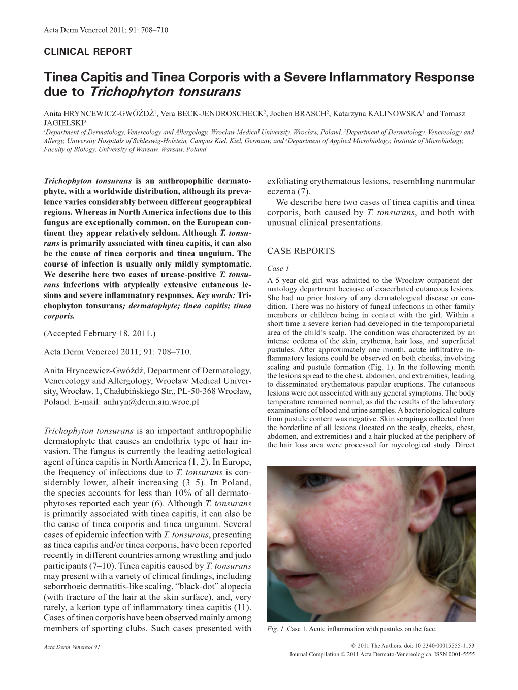 Tinea Capitis and Tinea Corporis with a Severe Inflammatory Response Due to Trichophyton Tonsurans