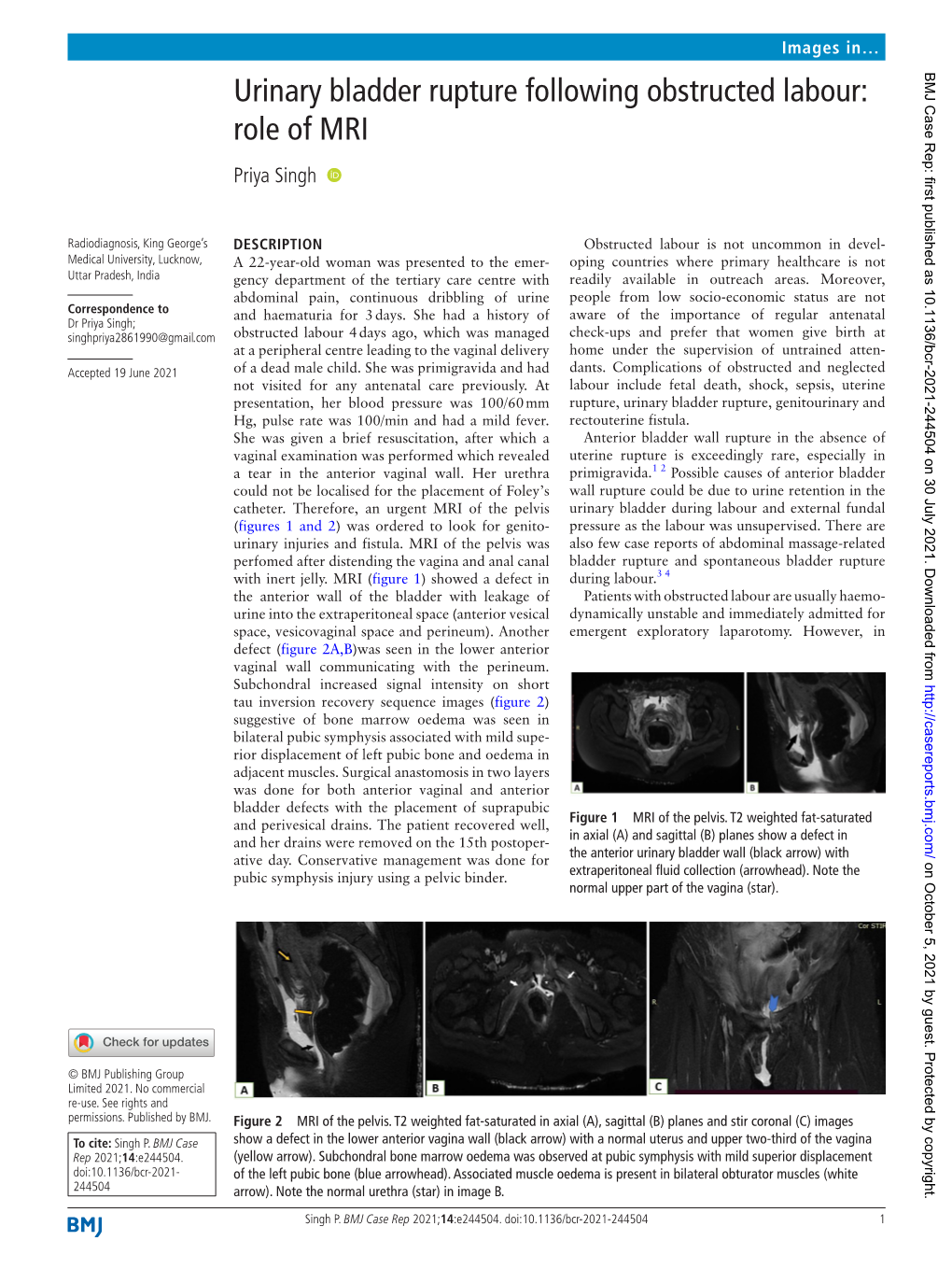 Urinary Bladder Rupture Following Obstructed Labour: Role of MRI Priya Singh ‍ ‍