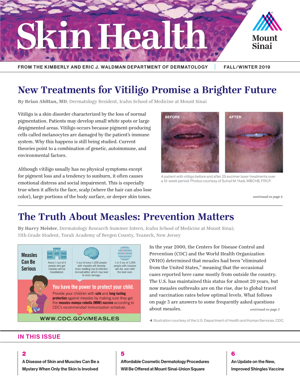 New Treatments for Vitiligo Promise a Brighter Future by Brian Abittan, MD, Dermatology Resident, Icahn School of Medicine at Mount Sinai