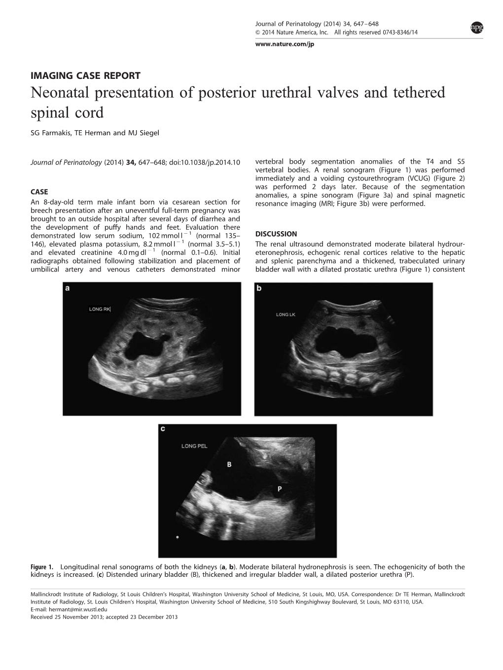 Neonatal Presentation of Posterior Urethral Valves and Tethered Spinal Cord