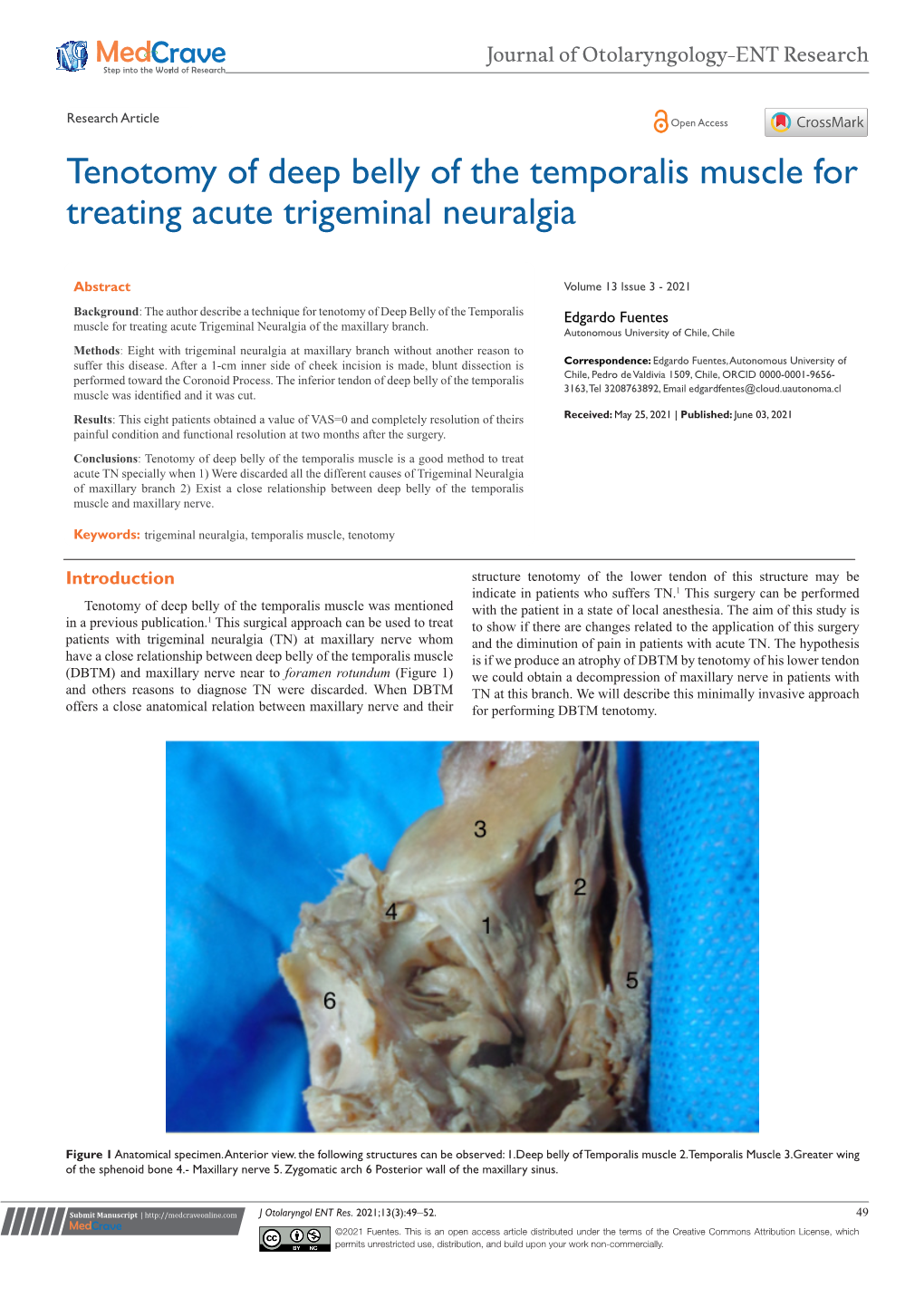 Tenotomy of Deep Belly of the Temporalis Muscle for Treating Acute Trigeminal Neuralgia