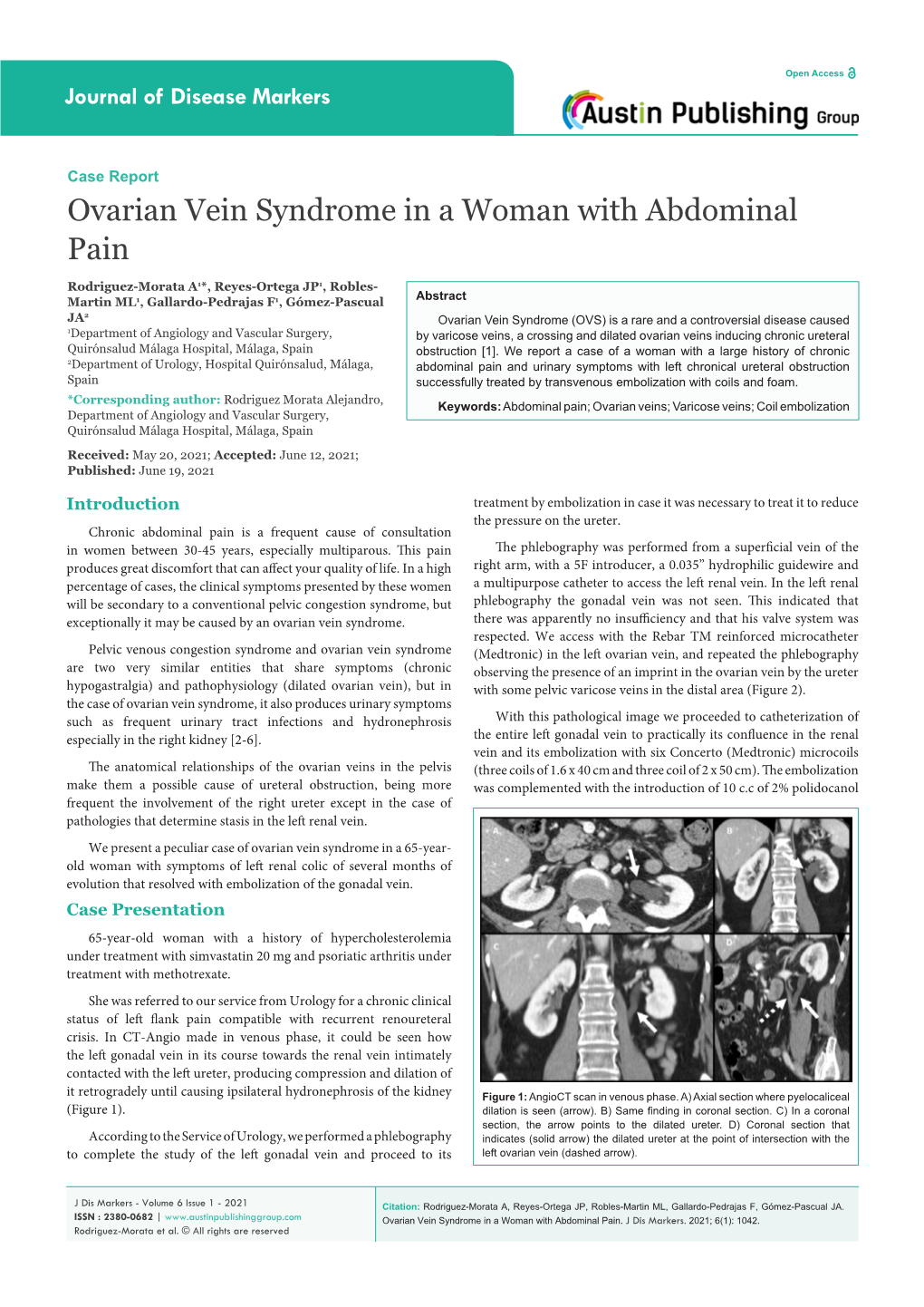 Ovarian Vein Syndrome in a Woman with Abdominal Pain