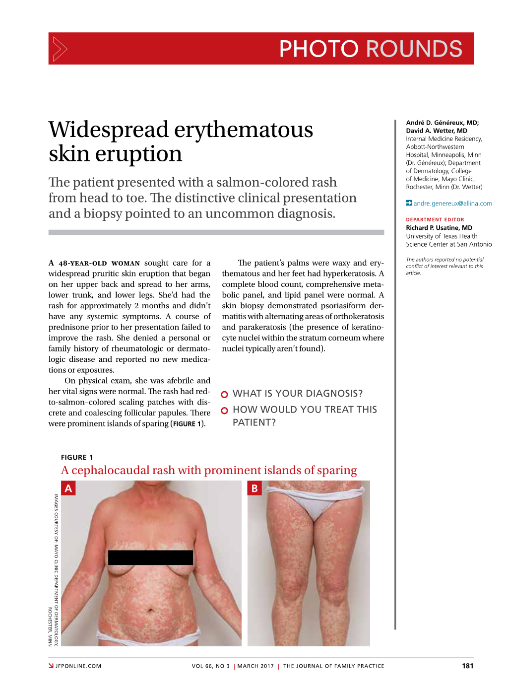 Widespread Erythematous Skin Eruption
