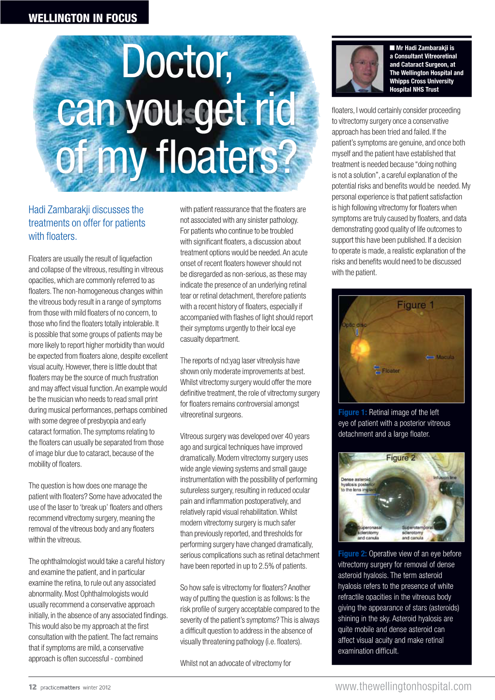 Guide to Vitrectomy for Floaters