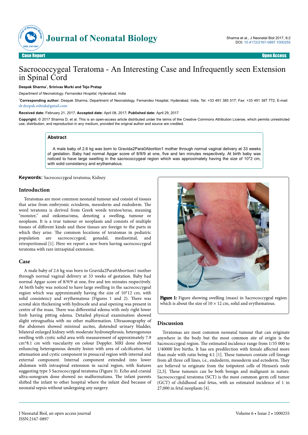 Sacrococcygeal Teratoma