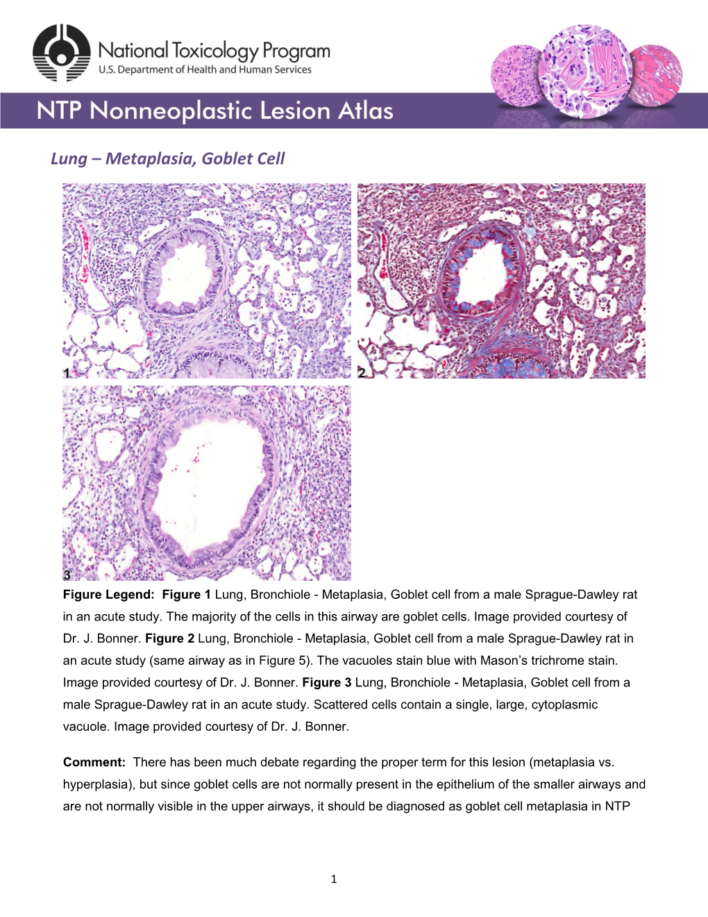 Lung – Metaplasia, Goblet Cell