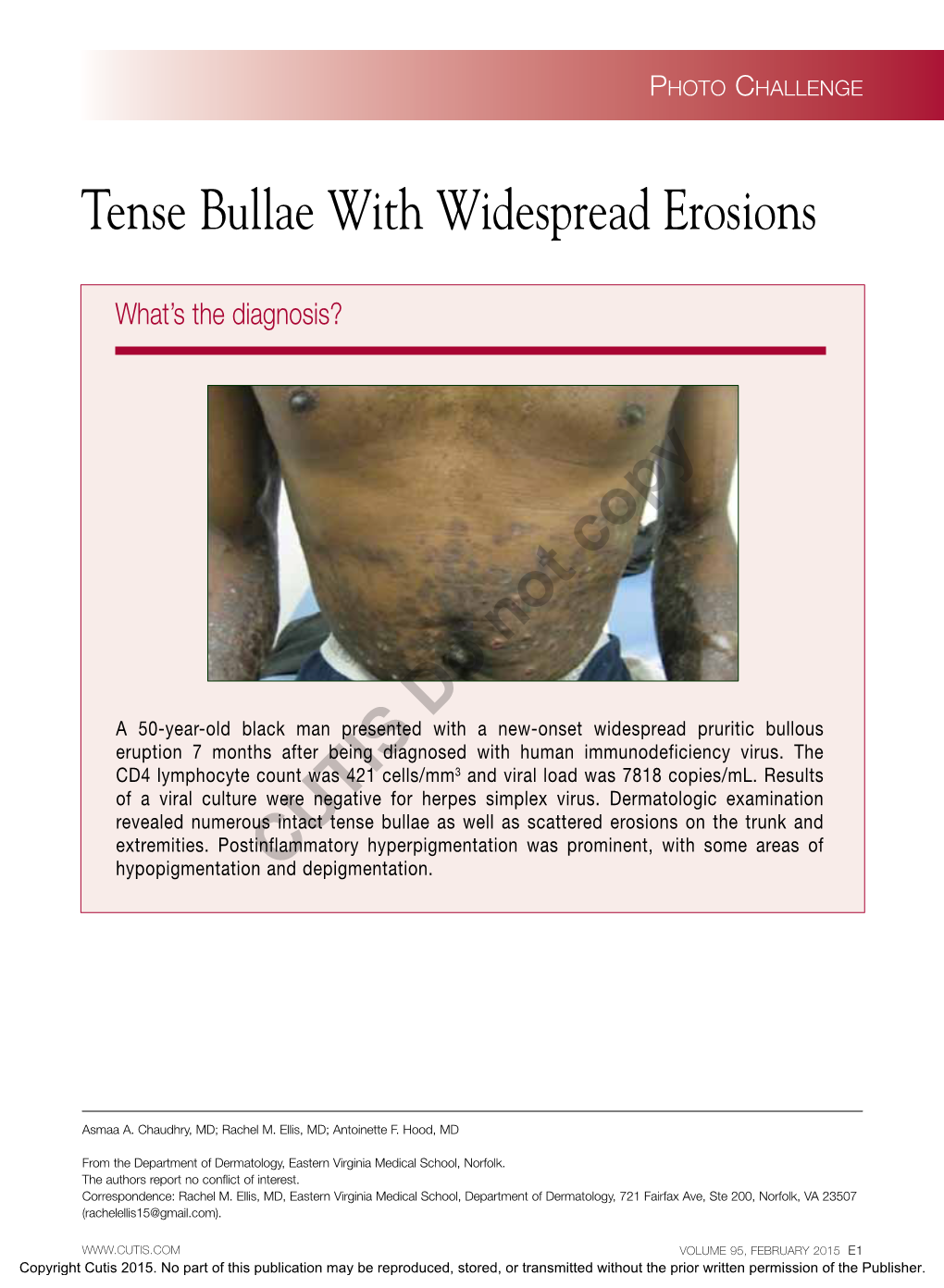 Tense Bullae with Widespread Erosions