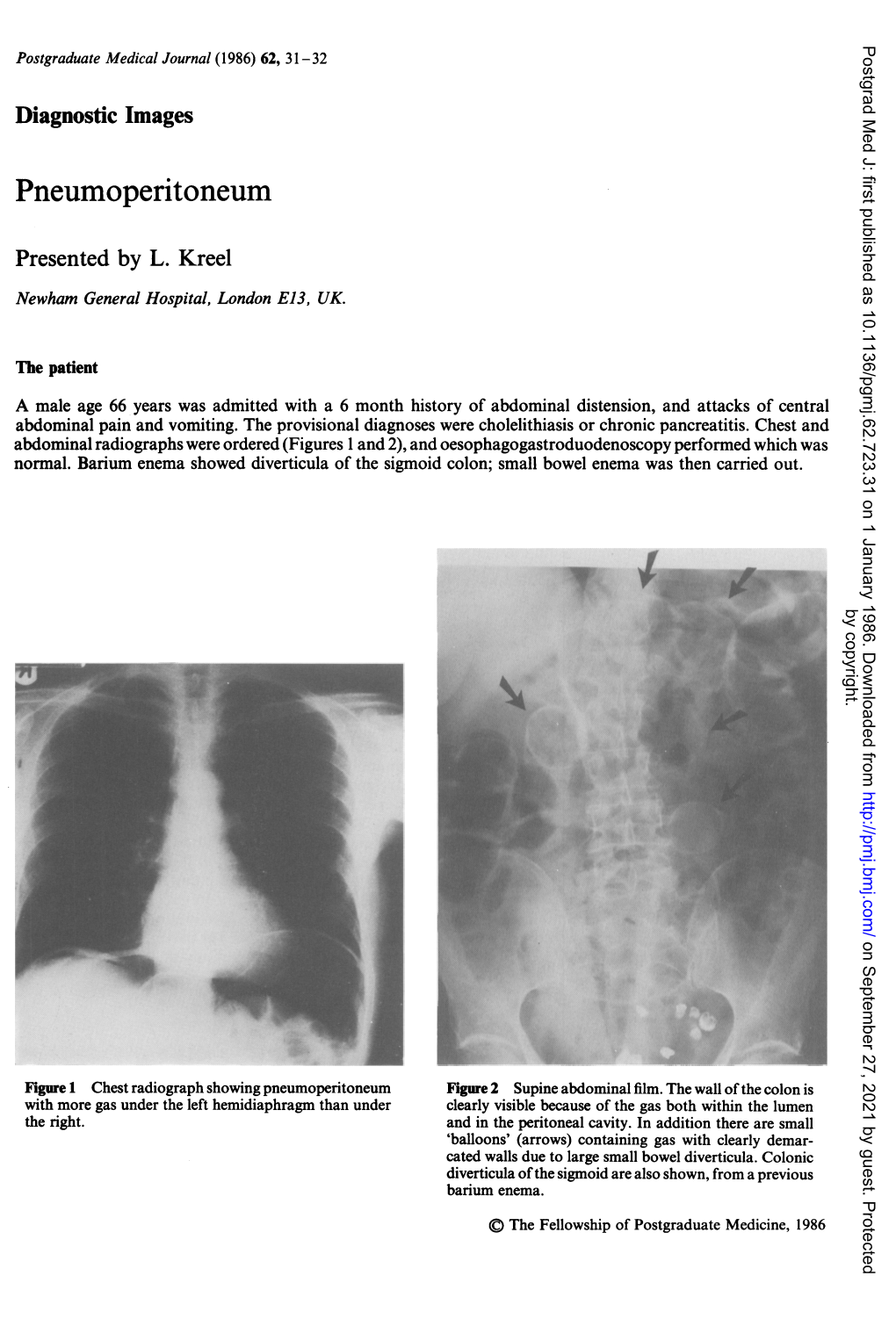 Pneumoperitoneum