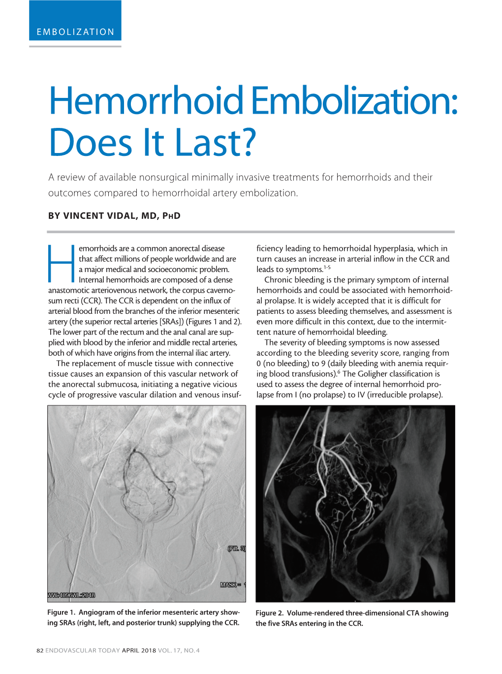Hemorrhoid Embolization