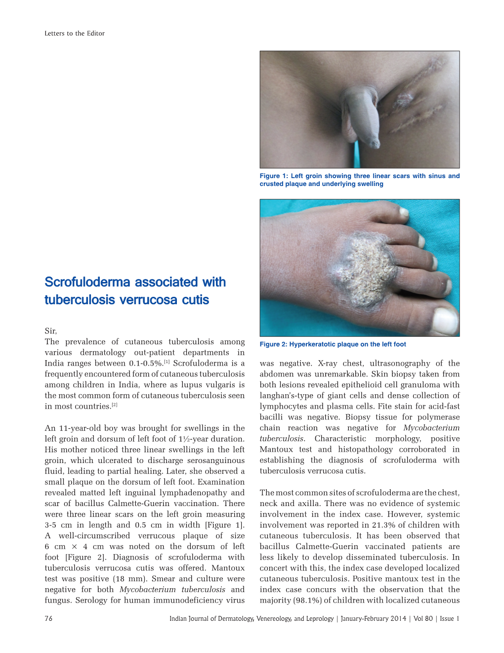 Scrofuloderma Associated with Tuberculosis Verrucosa Cutis