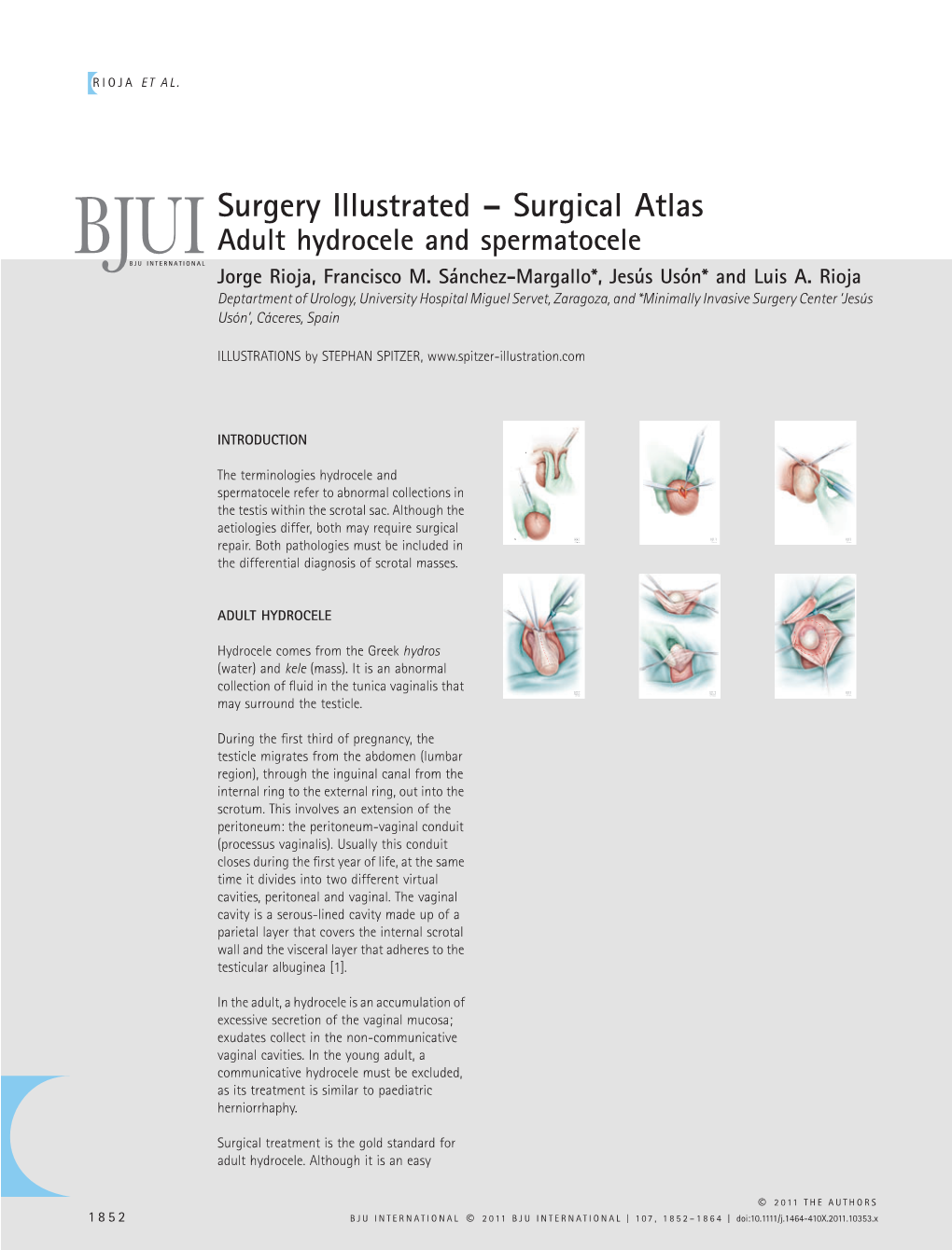 Surgery Illustrated – Surgical Atlas Adult Hydrocele and Spermatocele BJUIBJU INTERNATIONAL Jorge Rioja, Francisco M