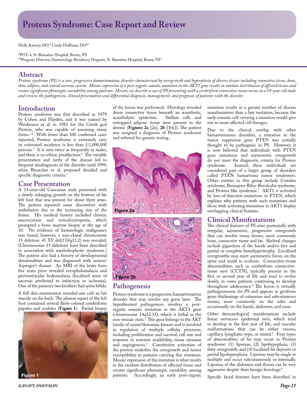 Proteus Syndrome: Case Report and Review