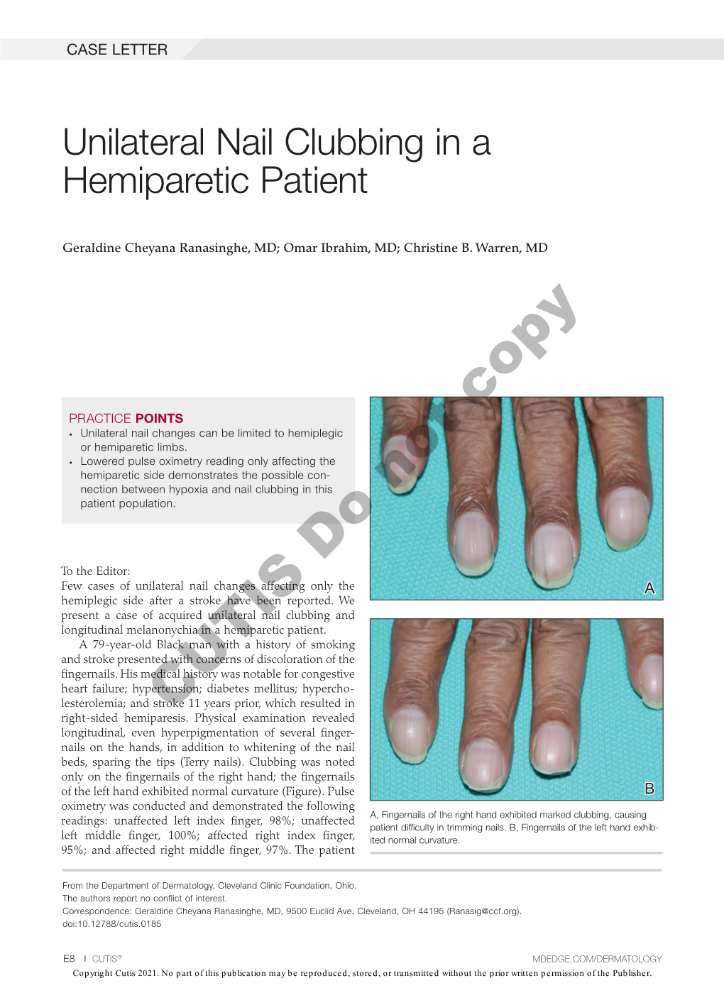 Unilateral Nail Clubbing in a Hemiparetic Patient