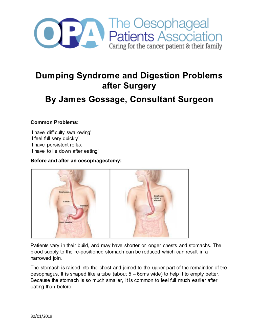 Dumping Syndrome and Digestion Problems After Surgery by James Gossage, Consultant Surgeon
