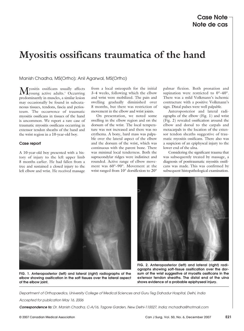 Myositis Ossificans Traumatica of the Hand