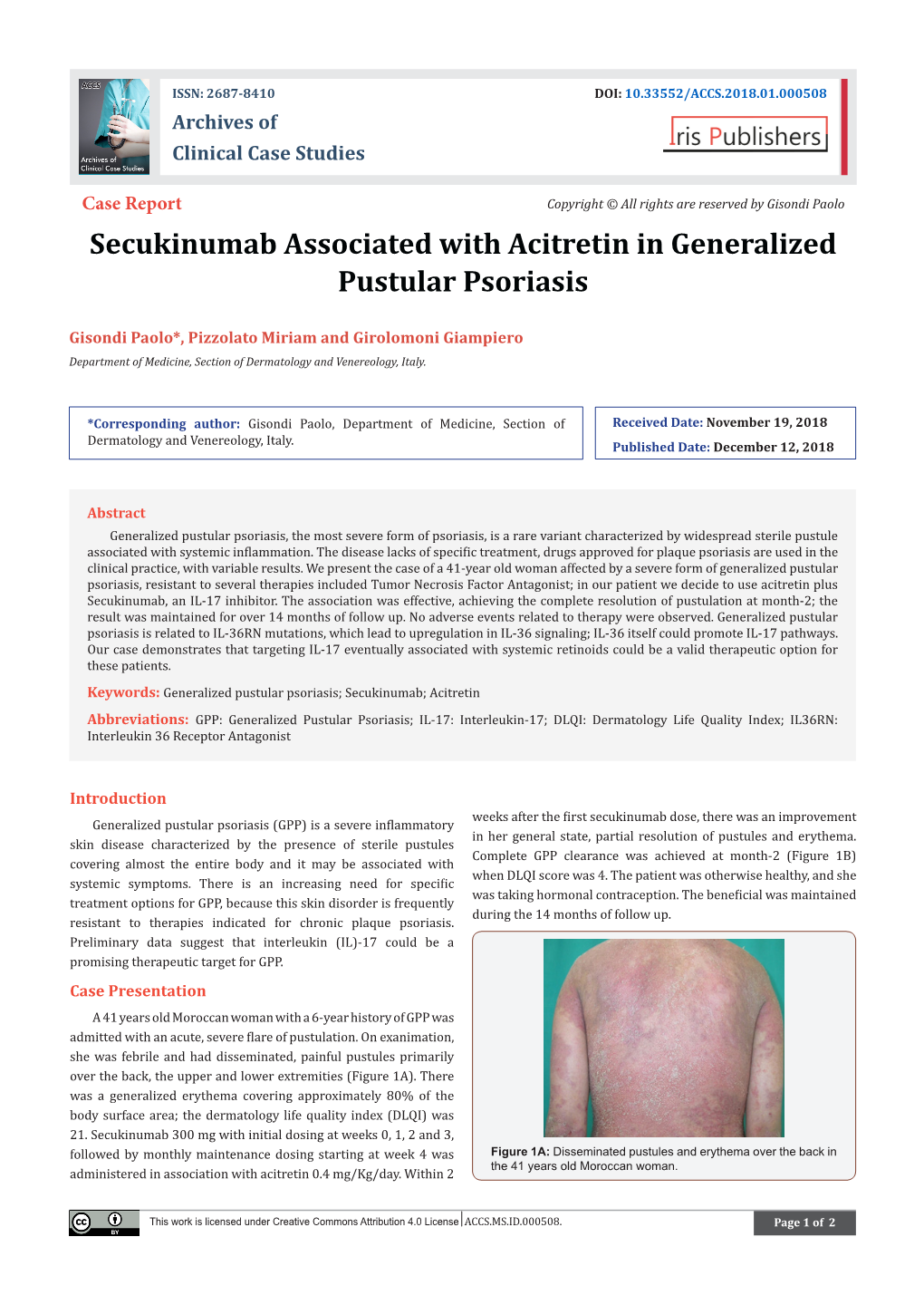 Secukinumab Associated with Acitretin in Generalized Pustular Psoriasis
