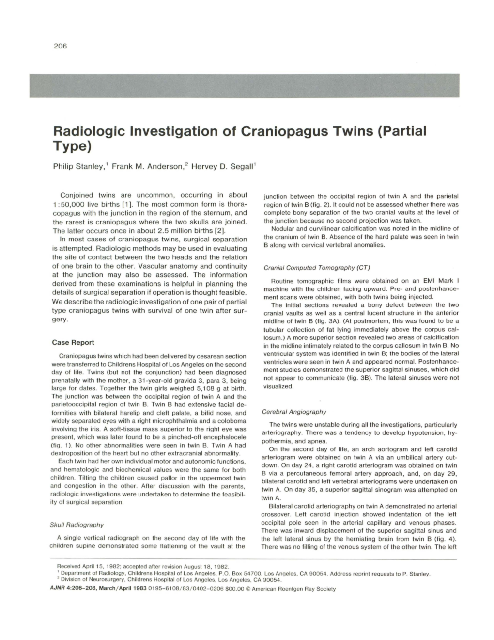 Radiologic Investigation of Craniopagus Twins (Partial Type)