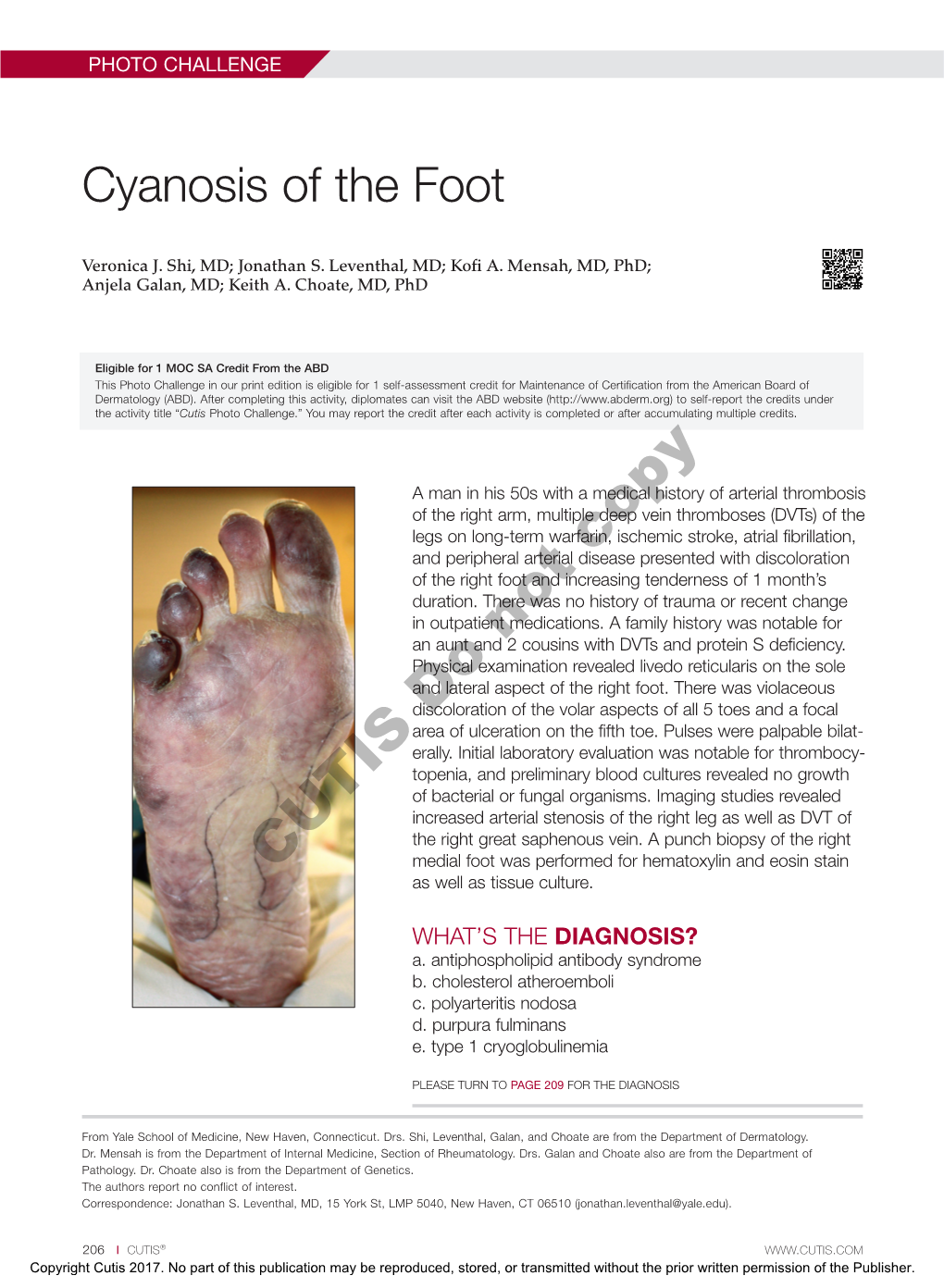 Cyanosis of the Foot