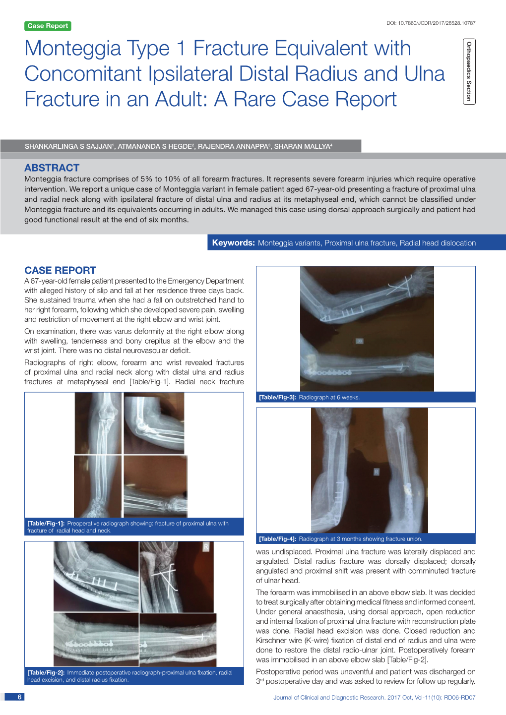 Monteggia Type 1 Fracture Equivalent with Concomitant Ipsilateral Distal Radius and Ulna Fracture in an Adult