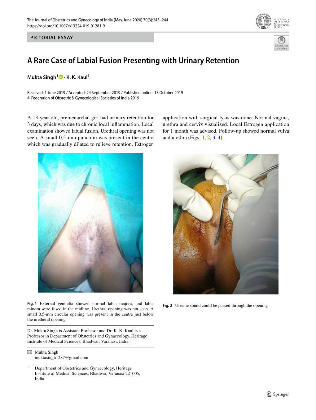 A Rare Case of Labial Fusion Presenting with Urinary Retention